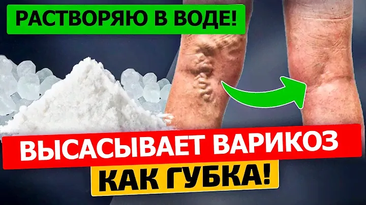 Об этом средстве забыли! Мощное СРЕДСТВО ОТ ВАРИКОЗА, боли в ногах, отеков и усталости!