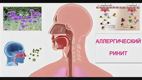 Поллиноз (Сенная лихорадка, Сезонный Аллергический Риноконъюнктивит)